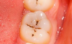 正畸后最后一颗牙窝沟龋，为何发生对口腔有何影响又该如何有效解决？