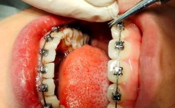 福州地包天矫正哪种方法效果更好性价比更高？