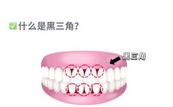 黑三角牙齿处理方法