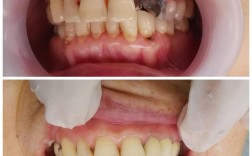 牙齿打桩能矫正牙齿吗？打桩矫正安全有效吗？