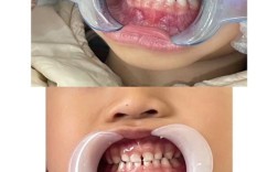 小孩牙齿矫正的图片