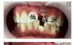 牙冠延长手术的常用方法具体有哪些呢？