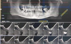 上颔窦正畸牙研究进展，临床应用面临哪些挑战与突破？