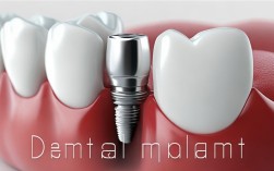 2025最新牙种植体款式有哪些？热门款图片欣赏