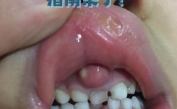 种牙后肿胀一般几天能消？