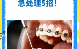 正畸结扎丝怎么固定才牢固？