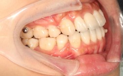 正畸下合磨牙舌倾6