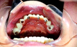 拔牙后即刻种植可行吗？效果与风险如何？