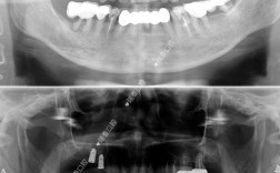 种牙可以核磁共振吗