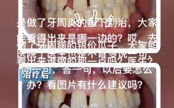 龈下刮治后多久能开始正畸？