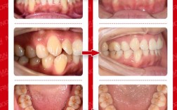 牙齿矫正前后对比图，效果真有那么惊艳吗？