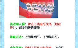 正畸颌间牵引定义