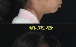 南京小孩矫正牙齿，矫正方式怎么选更合适？