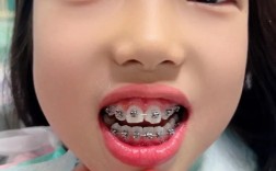 澳大利亚矫正牙齿费用高不高？大概需要多少预算？