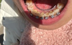 正畸内侧颚骨吸收，原因是什么？如何应对？