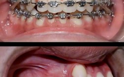 空牙种植矫正怎么做？效果与注意事项有哪些？