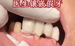 不种牙镶牙可行吗？有哪些替代选择？