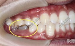 正畸关闭门牙间隙