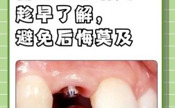 种植牙到底好不好？效果持久吗？有啥风险？哪些人适合？看完这些再决定！