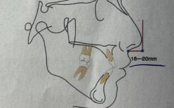 口腔正畸模型测量分析如何提升正畸精准度？