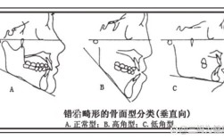口腔正畸ANB是什么？测量有何意义？