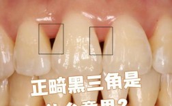 牙齿矫正后黑三角会自行变好吗？