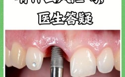 全口牙缺失种植牙风险高吗？这些隐患你必须知道！