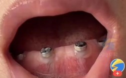 上牙突出拉回矫正后，种牙需要注意什么？