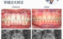 门牙有缝怎么矫正？有哪些实用矫正方法？