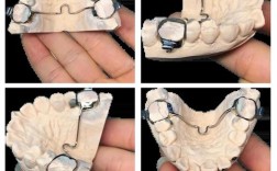 正畸腭杠腭托的制作方法与操作步骤是怎样的？