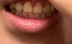 牙齿矫正期间牙龈增生