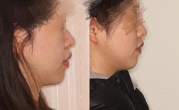 牙齿矫正后为何还嘴凸？矫正方案哪里出了问题？