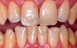 矫正后牙齿会松动吗？正畸医生解答