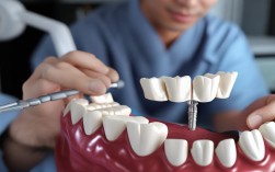 种植牙半口桥效果如何？能维持多久？价格贵不贵？