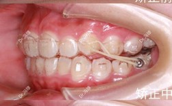 矫正咬合不齐牙齿，具体该怎么做？
