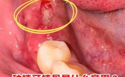 种牙植骨一直不成骨