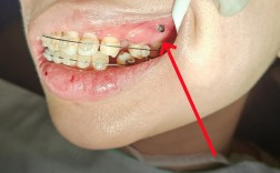 牙齿正畸拔骨钉