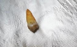 正畸牙拔完后痛几天