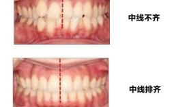 正畸 中线什么意思