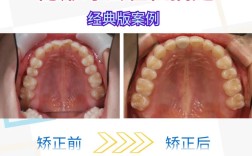 矫正牙齿牙套怎么戴？详细步骤与注意事项全解析