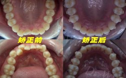 隐形矫正牙齿的坏处，真的像想象中那么少吗？