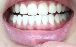 种牙后龈沟变浅是何原因？会影响种植牙使用效果吗？