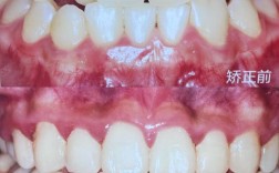 看完矫正牙齿前后对比照片，你敢信这是同一个人吗？