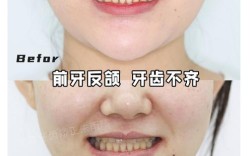 不拔牙矫正牙齿效果如何？真的可行吗？