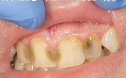 口腔钙化有哪些有效的治疗方法？