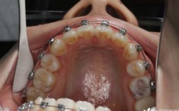 齿性龅牙正畸手术效果如何？