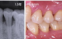 牙周手术植骨效果如何？恢复期需注意什么？多久能恢复正常？