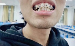 牙齿矫正半年后效果如何？变化明显吗？效果图能体现真实效果吗？