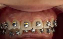 瑞典牙齿矫正有何独特优势？效果和费用如何？