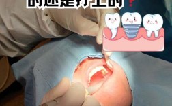 种牙的牙冠可以换吗